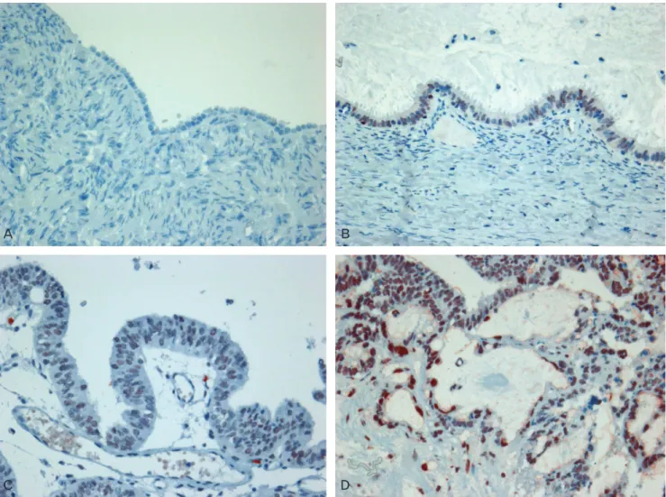 Fig. 3. Immunohistochemistry for poly (ADP-ribose) polymerase 1 (PARP1) in ovary (A) positive cells in normal ovarian surface epithelium, (B) positive  cells in serous adenoma, (C) positive cells in serous borderline tumor, and (D) positive cells in serous
