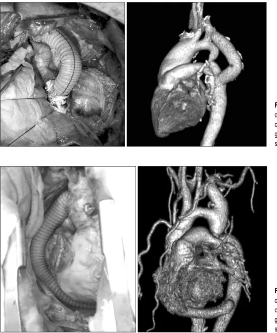 Fig. 3. Operative finding and post- post-operative 3-dimension CT image of  case 3. The course of bypass  graft is ascending aorta to  de-scending aorta.