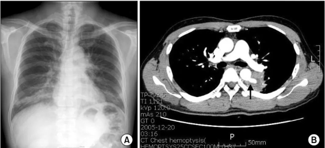 Fig. 1. (A) Preoperative chest X-ray  shows diffuse hazziness in both  lower lung fields