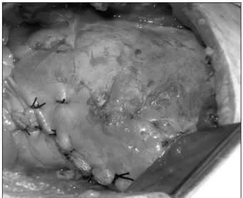 Fig. 3. Primary repair of the diaphragm using interrupted heavy  silk suture (case 1).