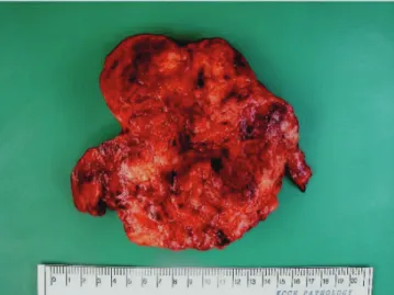 Fig. 1. Computerised tonography showed a large lobulating abdominal  mass infi ltrating the omentum with small amount of ascites