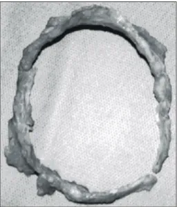 Fig. 3. The specimen of pericardial ring: The internal diame- diame-ter was 9.5×6 cm and the width was about 1∼1.5 cm.