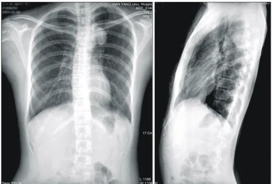 Fig. 1. Simple chest X-ray shows well maginated mass in  poste-rior mediastinum.