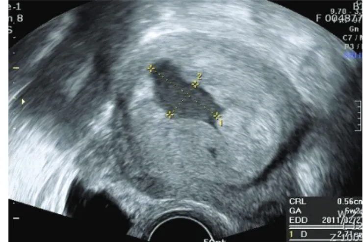 Fig. 2. Transvaginal sonography reveals a 27 × 15 mm sized subchorionic  hemorrhage during 1st trimester of pregnancy without defi nite  heman-giomas around uterus
