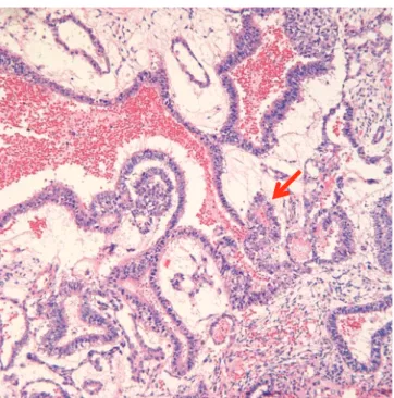 Fig. 3. Endodermal sinus tumor showing Loose reticular pattern and  round papillary process with central capillary (Schiller-Duval body) (arrow,  H&amp;E, ×200).
