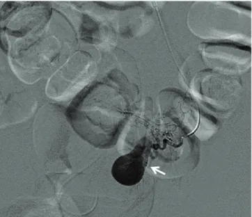 Fig. 2. The computed tomogram showed high attenuated sac like struc- struc-ture and extravasation from it after contrast infusion (arrow)