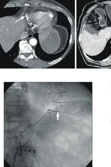 Fig. 2. CT angiographic evalua- evalua-tion. Computed tomographic  angi-ography demonstrates patent right gastroepiploic artery graft (white  arrow) and 2 cm sized fungating  mass on the posterior wall of the  gastric fundus (astrix).