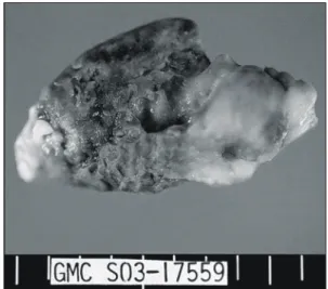 Fig. 3. Surgical specimen is shown which histologically  proved to be an organizing thrombus.