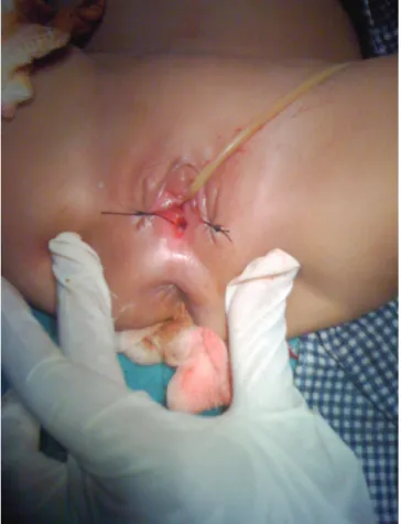 Fig. 2. Photograph of perineum showing vaginal orifi ce after resection of  septum and drainage of pyometra