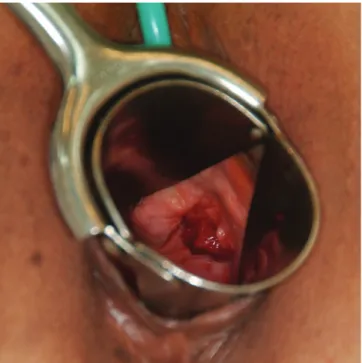 Fig. 1. Disruption of operation wound after 28 days after removing tape  and vaginal erosion.