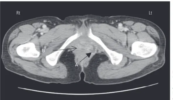 Fig. 3. The pelvic computed  tomography showing about  1.9 cm sized low density A left  outside and contrast enhanced  its around areas B after second  operation 5 days.