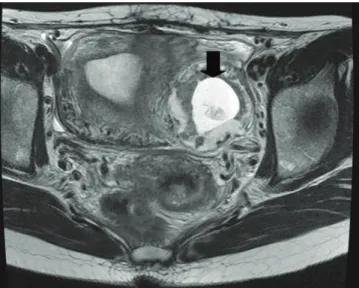 Fig. 2. Laparoscopic fi nding. There was about 2.5 cm sized bulging mass  (arrow) in the left posterolateral serosa of the uterus.