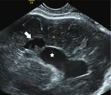 Fig. 3. Postnatal brain sonogram: Increased left periventricular echo- echo-genicity (white arrows), suggesting periventricular leukomalacia grade 1.
