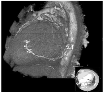 Fig. 2. The diagram showing operative procedures. Fig. 3. Postoperative MDCT image showing patent radial artery  bypass graft between descending thoracic aorta and 1st diagonal  branch