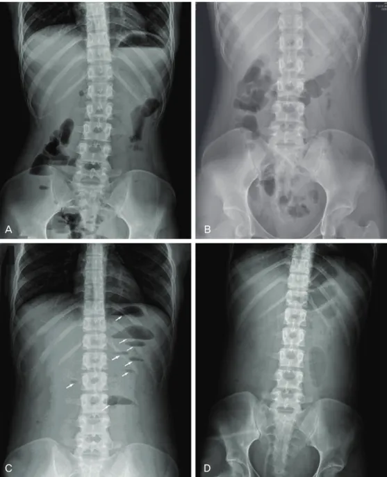 Fig. 1. Plain abdominal radiog- radiog-raphy. Upright (A) and supine (B)  abdominal radiographs showed  focal ileus in right upper quadrant  and pelvic cavity and there is no  small bowel dilatation and normal  transverse colon gas shadow is seen  on day 1