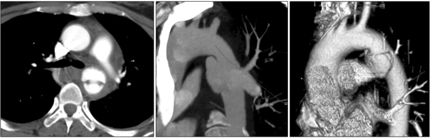 Fig. 1. These figures show a pseudoaneyrysm in the proximal descending thoracic aorta.