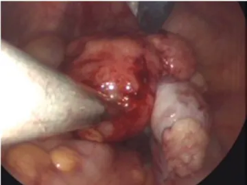 Fig. 1. Poor delineation of the right ovarian mass measuring about 8cm  in length on computed tomography.