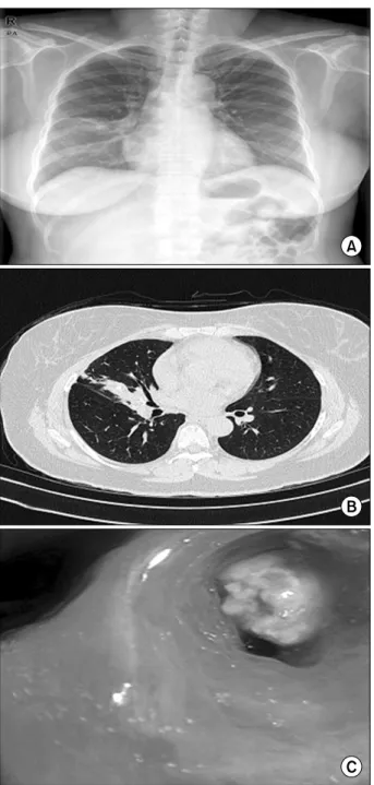 Fig. 2. Gross finding of resected specimen showing multiple calcified  endobronchial nodule (white) in the bronchus of the right middle lobe  (A)