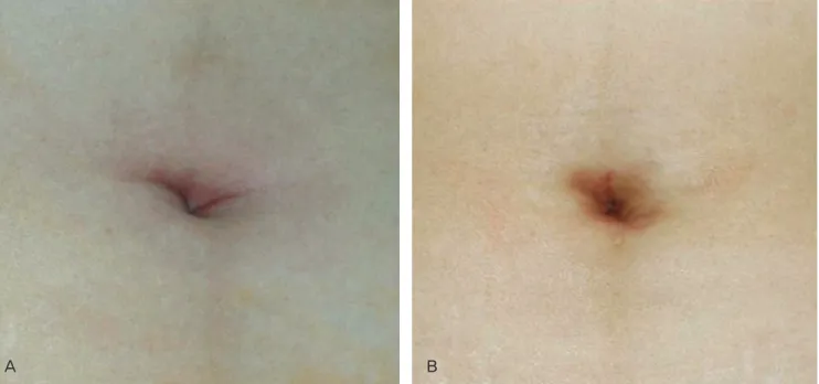 Fig. 2. Postoperative fi nding of umbilical scar’s. (A) Preoperative and (B) postoperative (4 weeks later) fi nding.