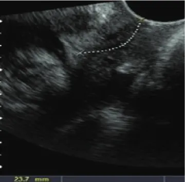 Fig. 3. Transvaginal sonogram of the cervical length at 35 weeks of ges- ges-tation (20 mm).