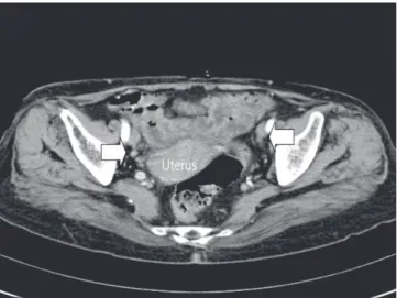 Fig. 2. Positron emission tomography findings of abnormal fluoro-D- fluoro-D-glucose uptake in whole cervix mass.