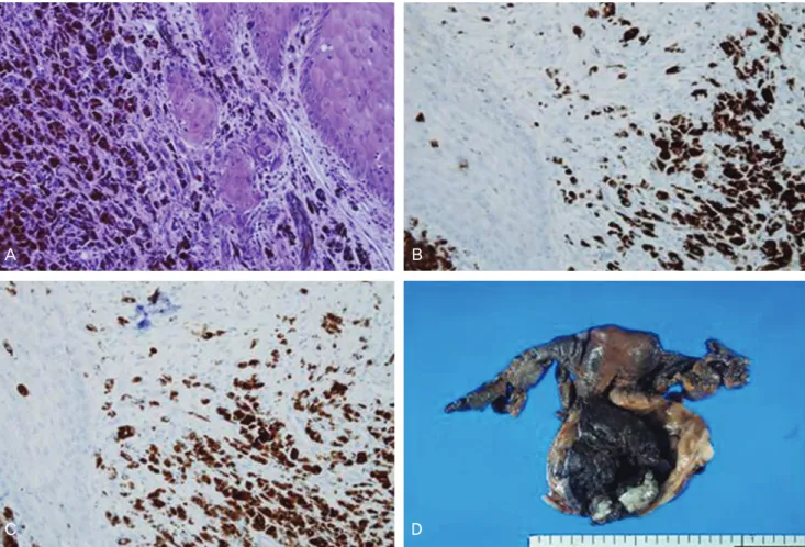Fig. 3. Histologic fi ndings are showing proliferation of malignant melanin-producing melanocytes (A)