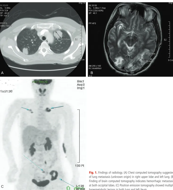 Fig. 1. Findings of radiology. (A) Chest computed tomography suggested  of lung metastasis (unknown origin) in right upper lobe and left lung