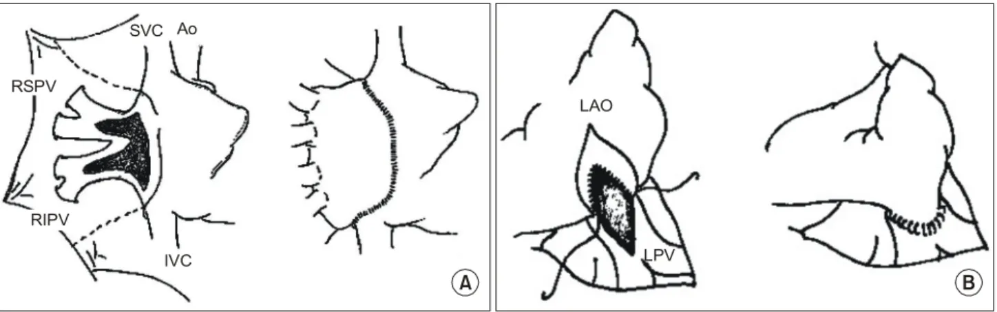 Fig. 3. Postoperative 2D-Echocardiogram.  A: The color Doppler shows increased right pulmonary venous flow velocity