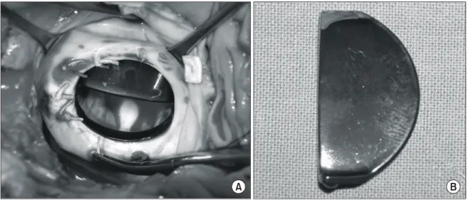 Fig. 2. Escaped leaflet (white arrow) founded on abdominal  CT. 