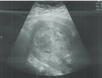 Fig. 5. Transvaginal sonogram 4 weeks after operation showed a thin  linear endometrial cavity and no remnant placental tissue.