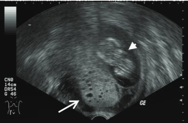 Fig. 2. Magnetic resonance imaging demonstrates normal fetus (thin arrow) of 13 weeks of pregnancy with anterior wall placenta at the right upper  portion of uterus, and multiloculated cystic mass (thick arrow) with high signal intensity on T2-weighted ima