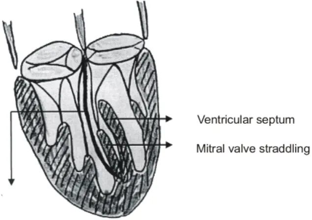 Fig. 1. Closure of ventricular septal defect in the patient with mitral valves straddling.