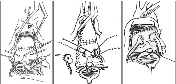 Fig. 2. Modified technique of coronary artery transfer in arterial switch operation; reimplantaton of coronary artery buttons after neoaortic reconstruction.