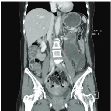 Fig. 1. Abdominal computed tomography scan on the 2nd day after trauma. 