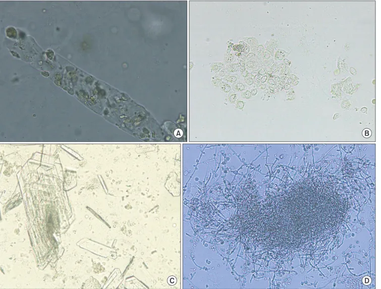 Fig. 2. Second urine sediments subjected to quality assessment in Korea. (A) Cellular cast (×400)