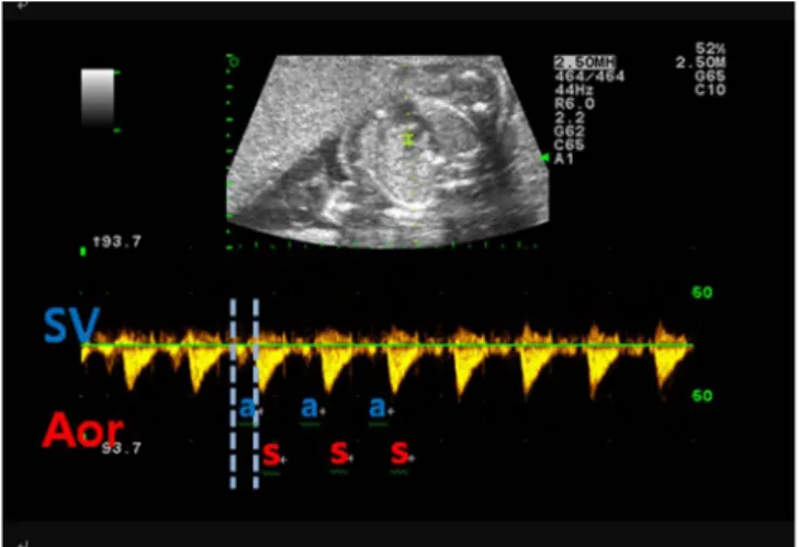 Fig. 2. Pulsed Doppler was done at 26+1 weeks of gestation. Checked  atrioventricular time intervals were 138 ms and 120 ms