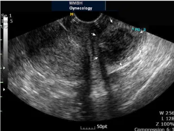 Fig. 3. Laparoscopic finding. Hematoma which black arrows point was  visible on retroperitoneal space