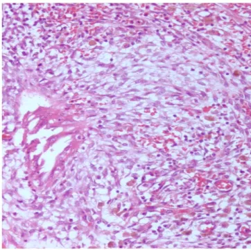 Fig. 3. Microscopic finding of the diaphragm showing endometrial stro- stro-mal tissue and glands (H&amp;E, ×200).
