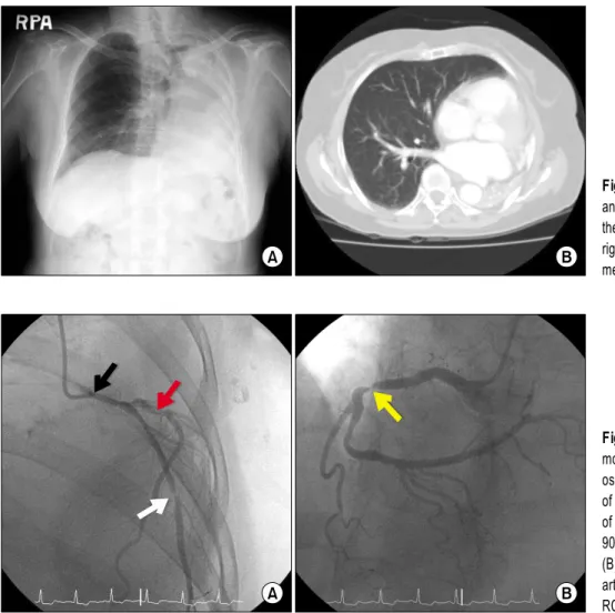 Fig. 1. Preoperative chest X-ray (A)  and chest CT (B) show absence of  the left lung, hyperinflation of the  right lung and mediastinal  displace-ment.
