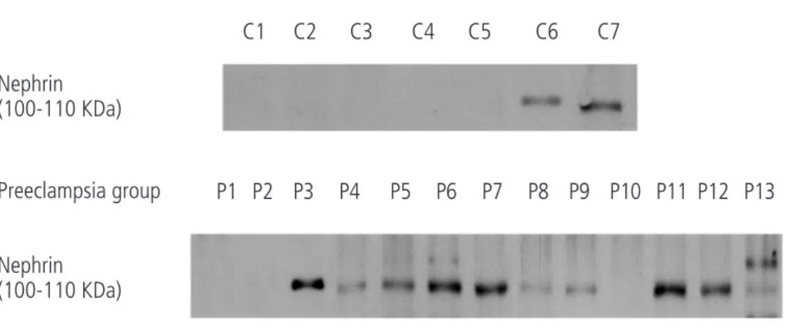 Fig. 1. Expression of nephrin  in  normal  and  preeclamptic  sera by Western blot.