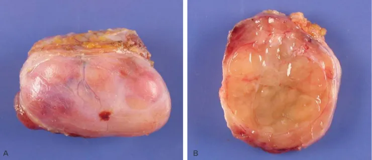 Fig. 3. Light microscopic findings show epithelioid tumor cells with variable atypia organized in nests and hyalinized stroma (A, H&amp;E, ×400) and tumor  cells having intracytoplasmic vacuolation (arrows) (B, H&amp;E, ×400)