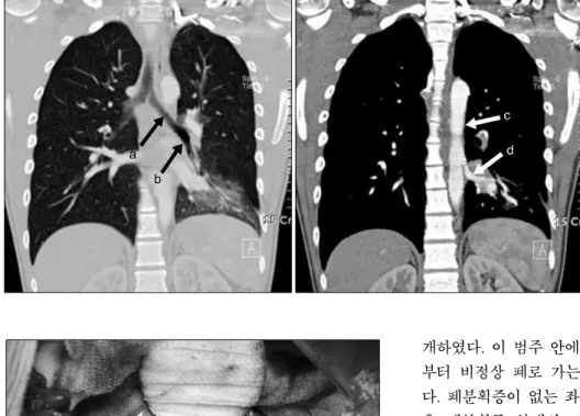 Fig. 1. Preoperative chest CT; the  anomalous systemic artery  originat-ing from the descendoriginat-ing aorta  sup-plied the basal segments of left  lower lobe and the normal  branch-ing pattern of the left lower lobar  bronchus was seen