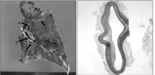 Fig. 3. Gross and microscopic  finding; There was no pulmonary  artery in basal segments and the  anomalous systemic artery had an  elastic-type arterial wall and mild  intimal thickening