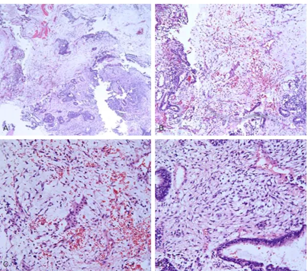 Fig. 2. The pathologic finding of immature teratoma, incisonal biopsy at right thigh palpable mass