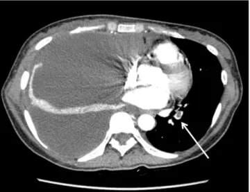 Fig. 1. Enhanced computed tomography scan of chest showing pulmo- pulmo-nary embolism (arrow) and massive right pleural effusion