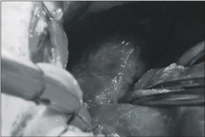 Fig. 2. Resected mass with fibropurulent abscess formation  inside, and hemorrhages on the surface.