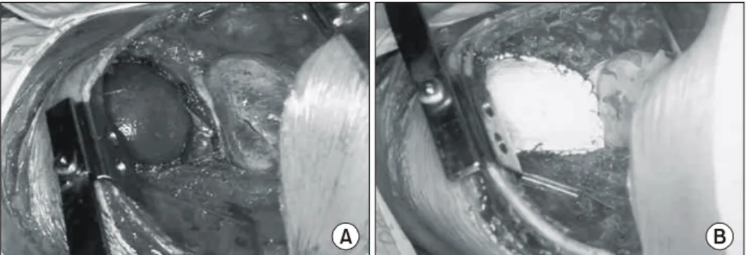 Fig. 3. Gross and microscopic find- find-ings of tumor. (A) gross specimen, (B) microscopic specimen (H&amp;E  stan-ing, ×400).