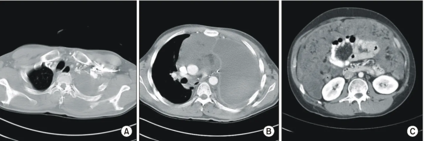 Fig. 5. Follow-up images.  (A) and (B) chest computed tomography at 2 months after operation; low attenuated lesion in left back muscle (A) and mass shadow in anterior mediastinum (B), (C) abdominal computed tomography at 9 month after operation shows peri