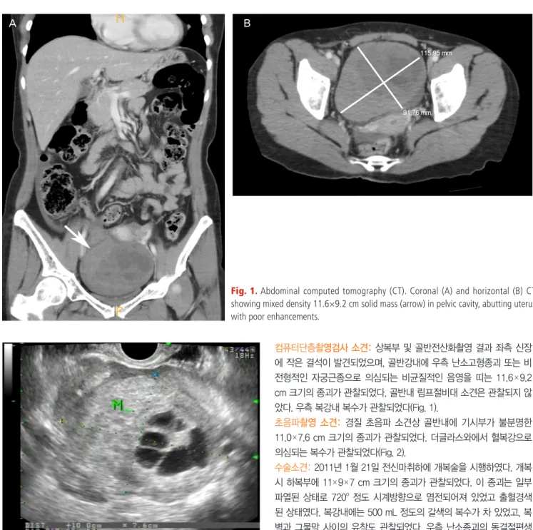 Fig. 1. Abdominal computed tomography (CT). Coronal (A) and horizontal (B) CT  showing mixed density 11.6×9.2 cm solid mass (arrow) in pelvic cavity, abutting uterus  with poor enhancements.