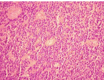 Fig. 3. Dense cellular neoplasm, composed of ovoid cells with inter- inter-spersed small arterioles (H&amp;E, ×40).